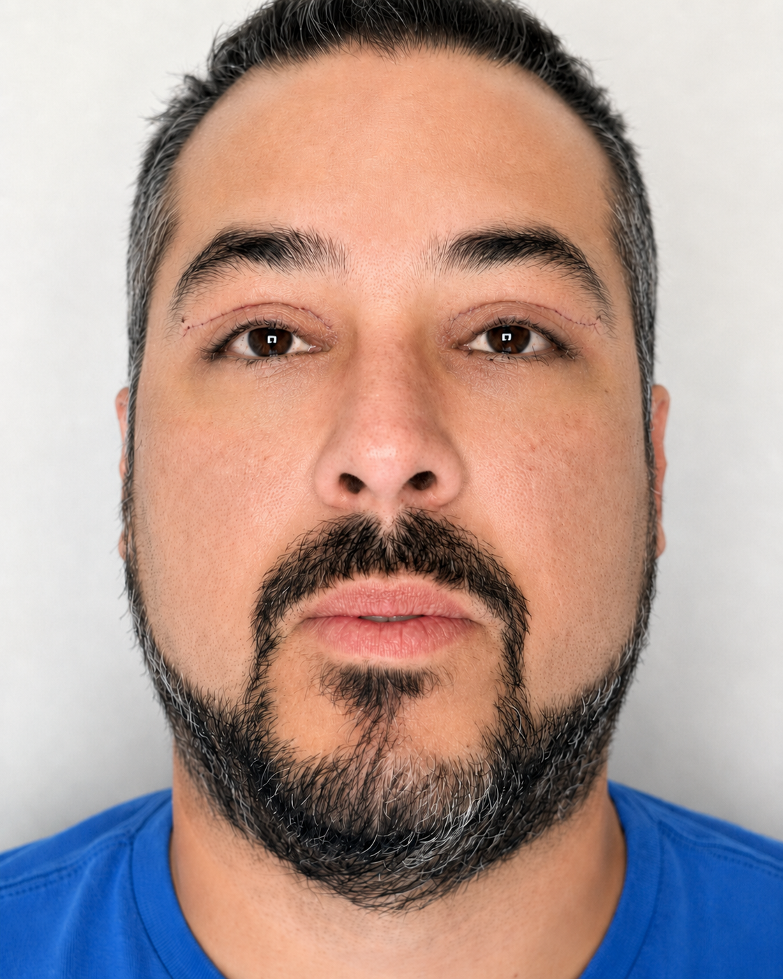 Depois de blefaroplastia