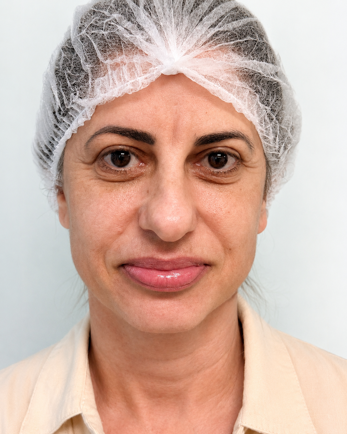 Antes de rinoplastia